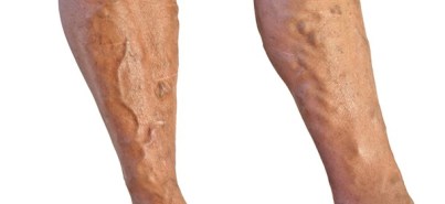 Varicose Veins