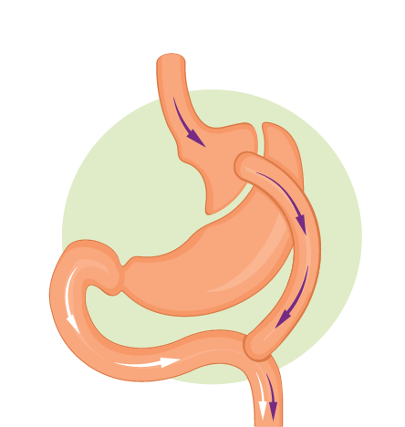 Gastric Bypass