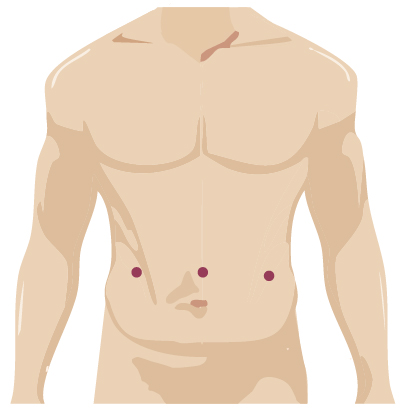Robotic surgery incision for hernia