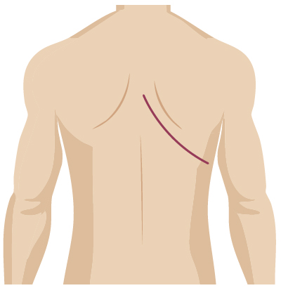 Traditional surgery incision for thoracic surgery